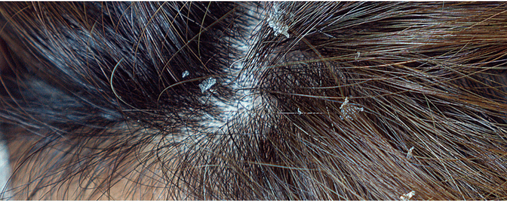 Dandruff &  Treatment - details