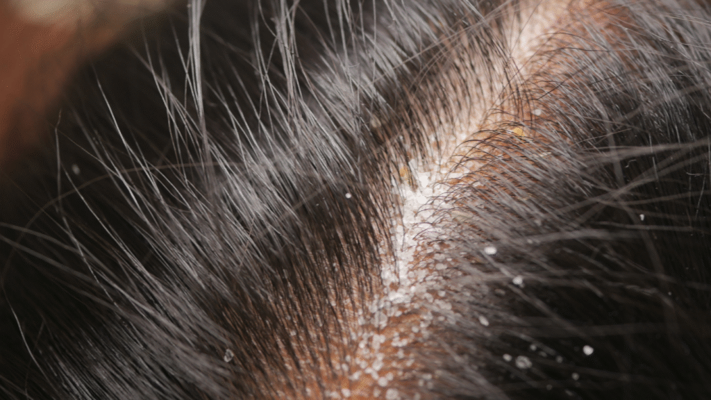 Dandruff &  Treatment - details