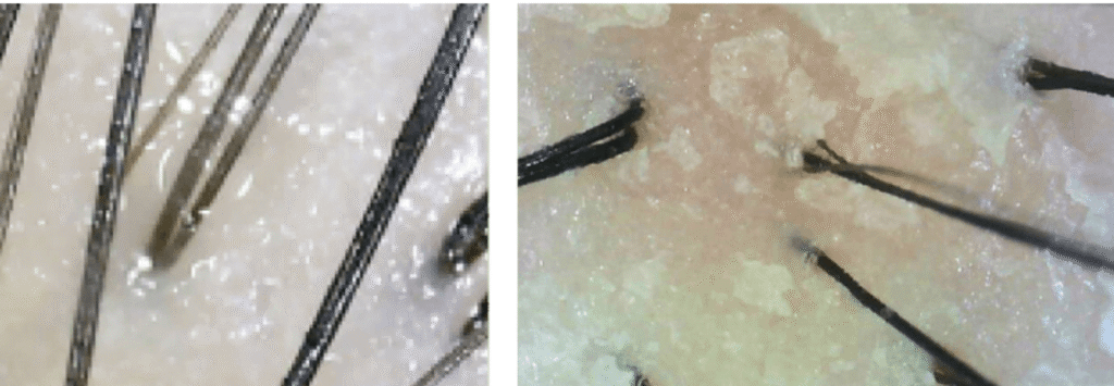 Dandruff &  Treatment - details