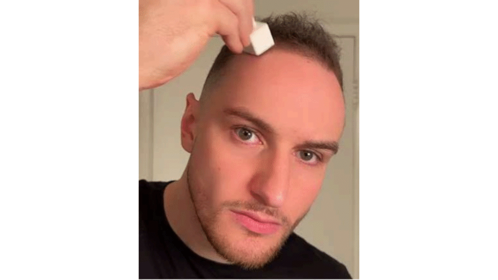 All about Micro Needling - details