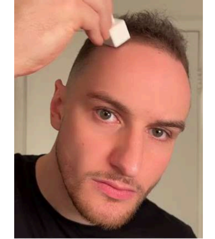 All about Micro Needling