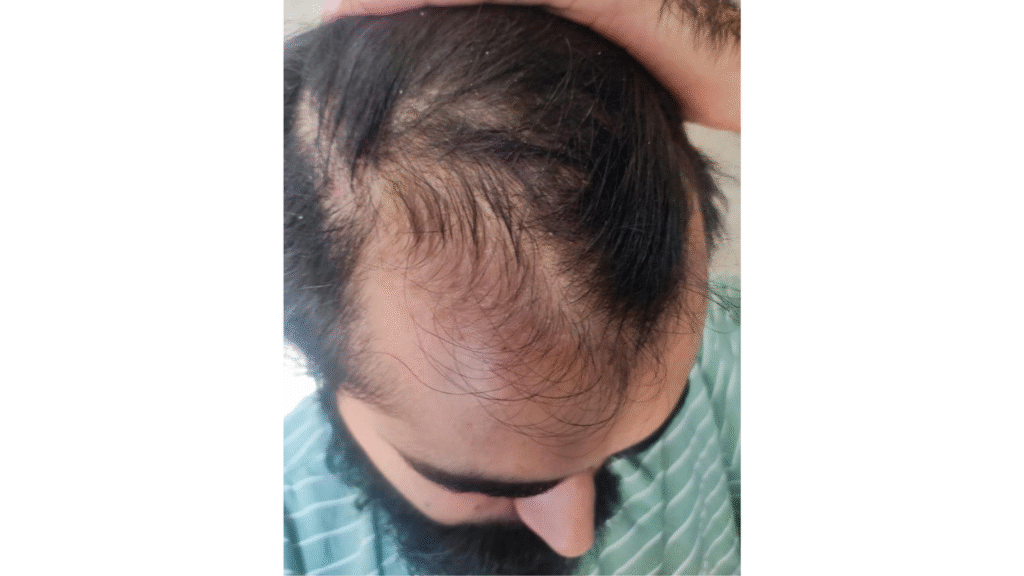 Case Study of Genetic hair loss - details