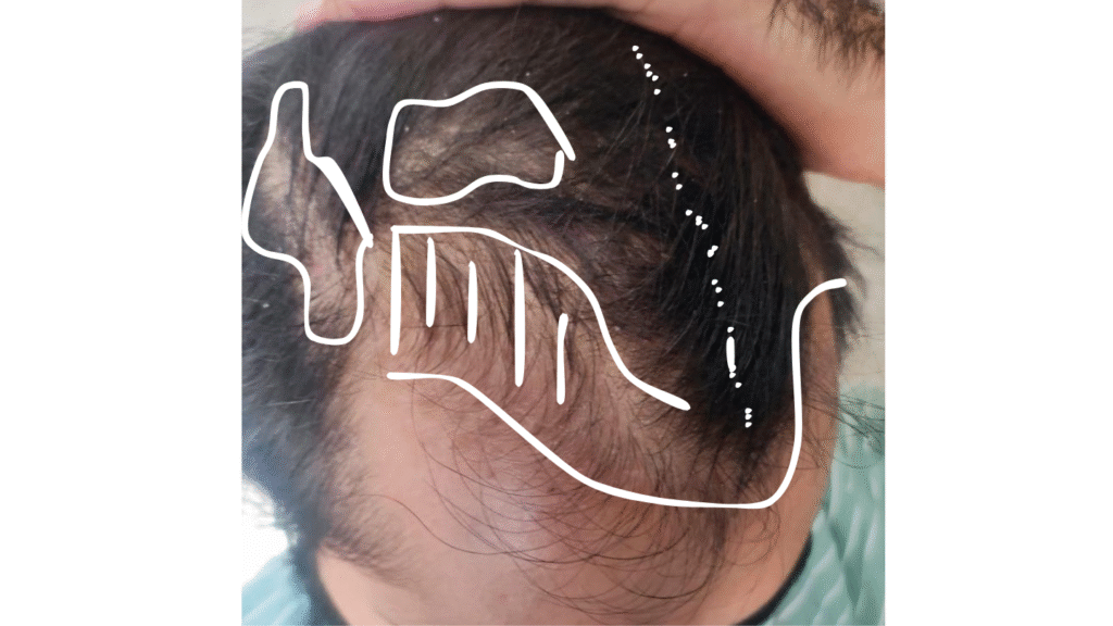 Case Study of Genetic hair loss - details