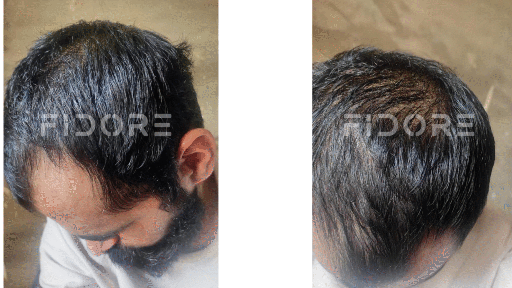 Case Study of Genetic hair loss - details