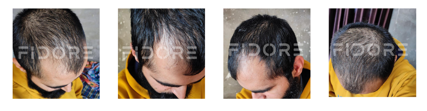 Case Study of Genetic hair loss - details