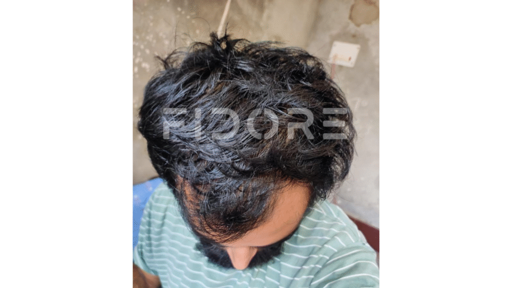 Case Study of Genetic hair loss - details