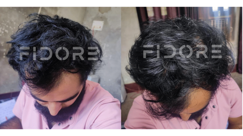 Case Study of Genetic hair loss - details