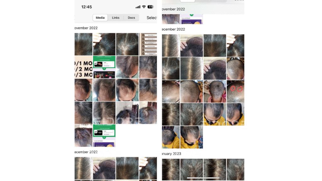 Case Study of Genetic hair loss - details