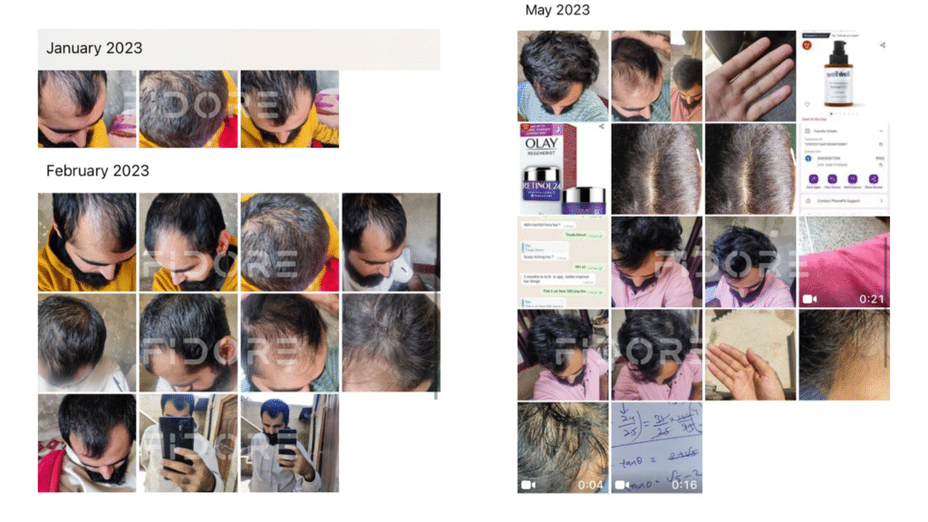 Case Study of Genetic hair loss - details