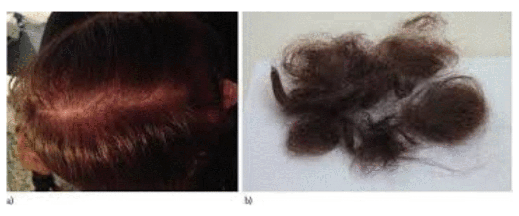 Telogen Effluvium - details