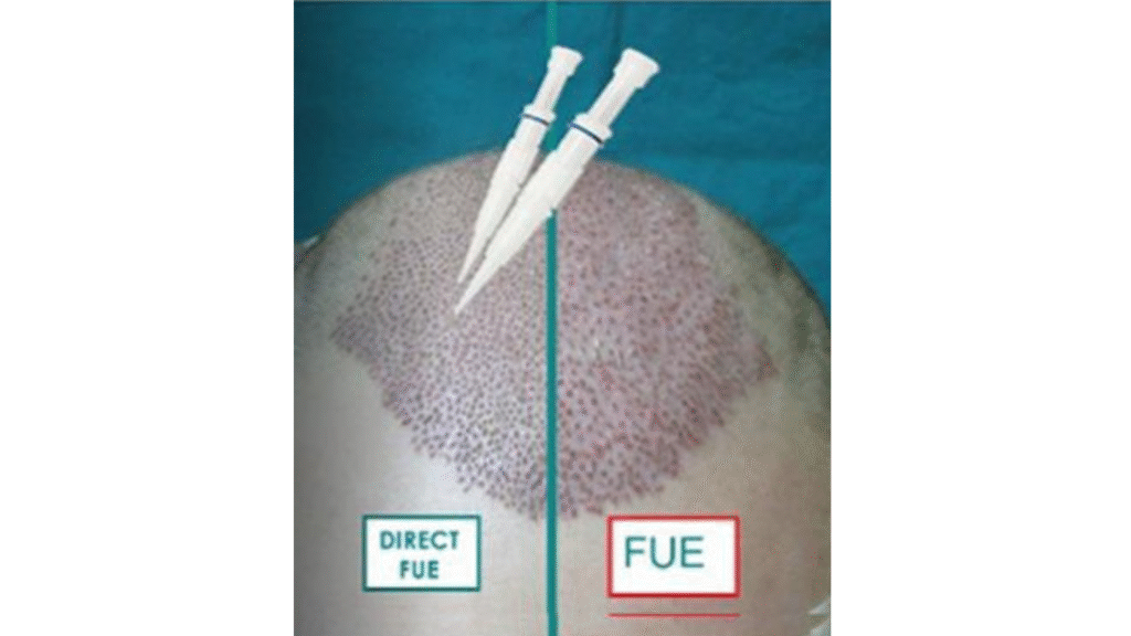 All About Hair Transplant - details