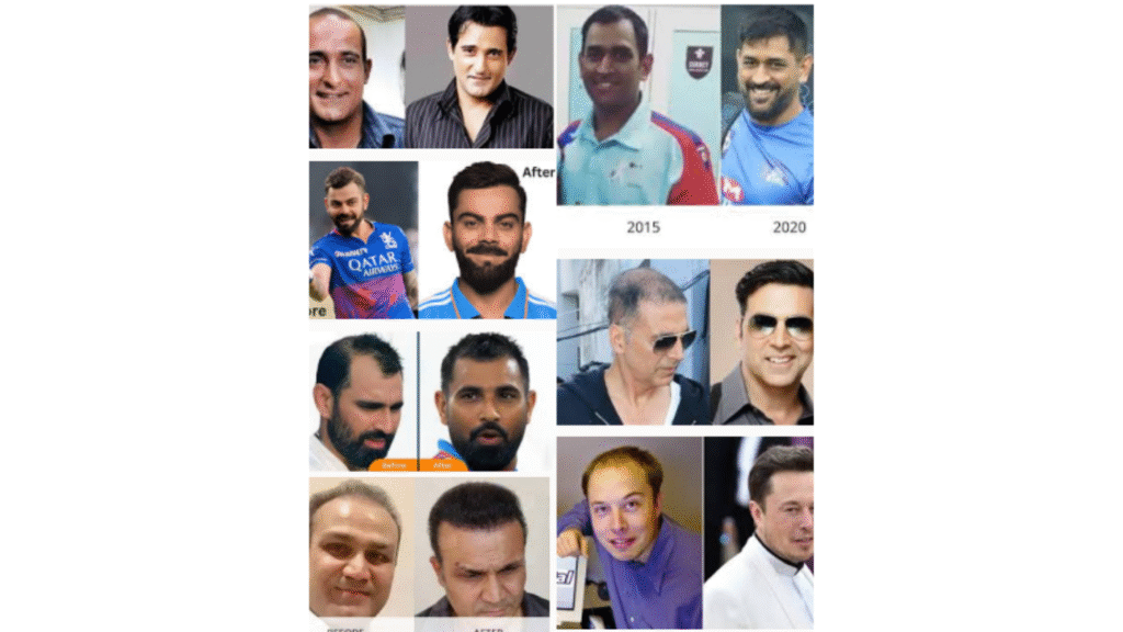 All About Hair Transplant - details