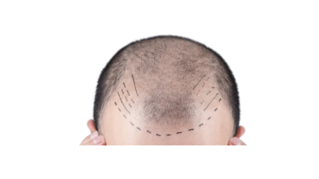 All About Hair Transplant - details
