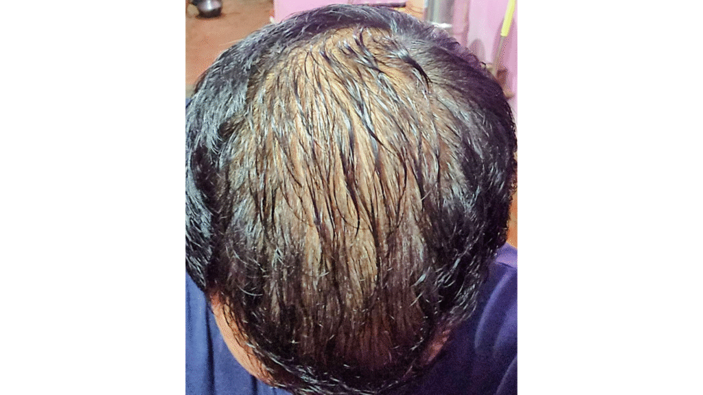 Explaining Andro Genetic Alopecia - details