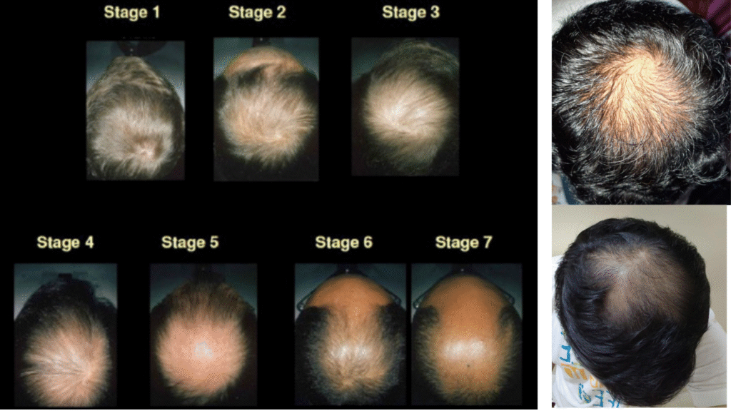 Explaining Andro Genetic Alopecia - details