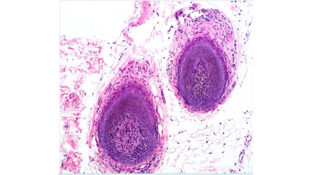 Explaining Andro Genetic Alopecia - details