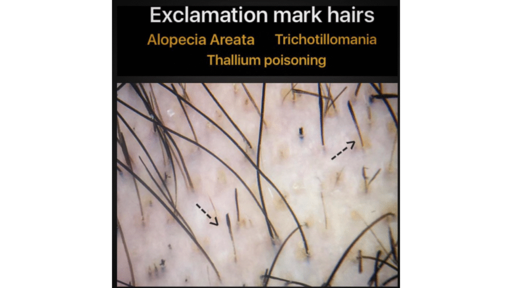 Explaining Andro Genetic Alopecia - details