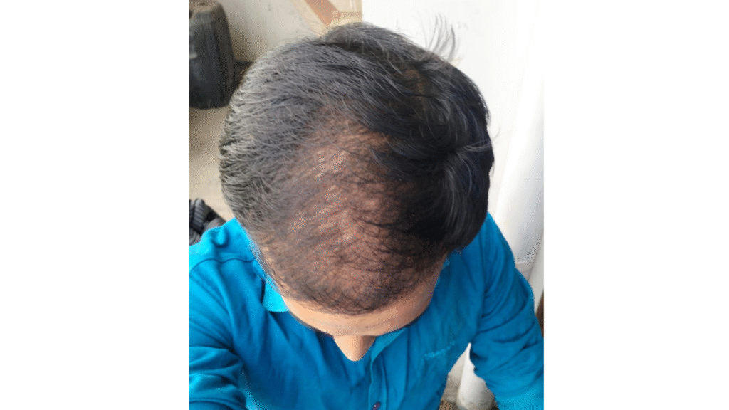 Case Study of Post  Transplant patient - details