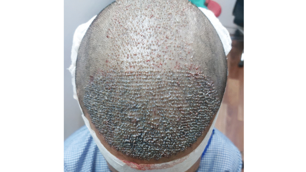 Case Study of Post  Transplant patient - details