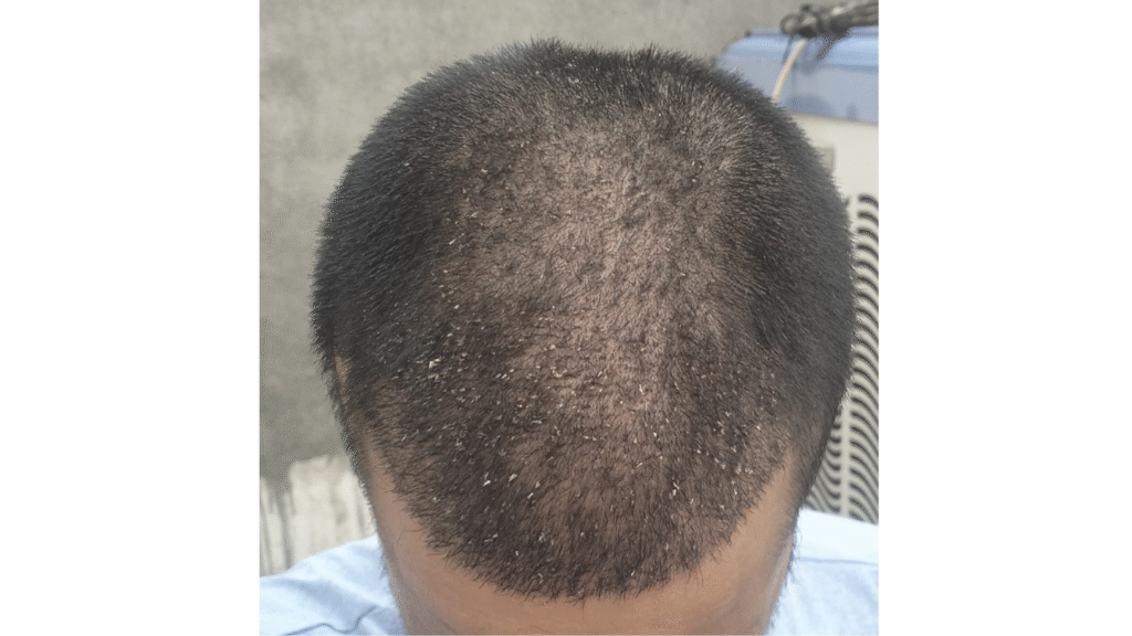 Case Study of Post  Transplant patient - details