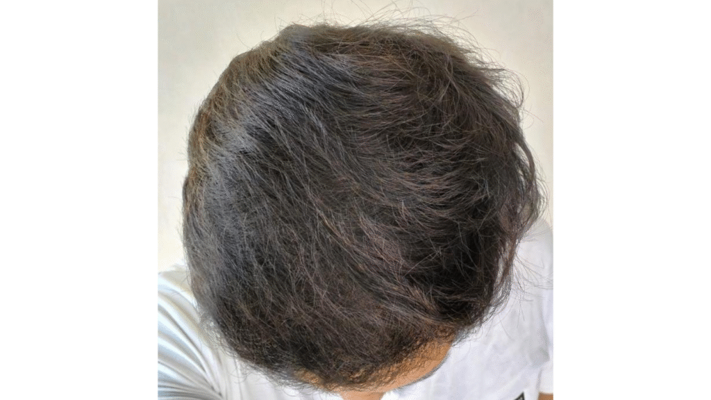 Case Study of Post  Transplant patient - details