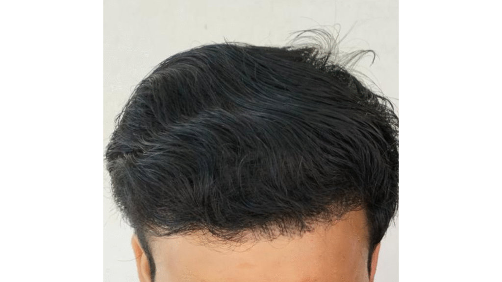 Case Study of Post  Transplant patient - details