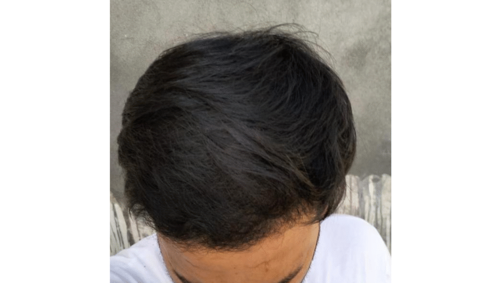 Case Study of Post  Transplant patient - details