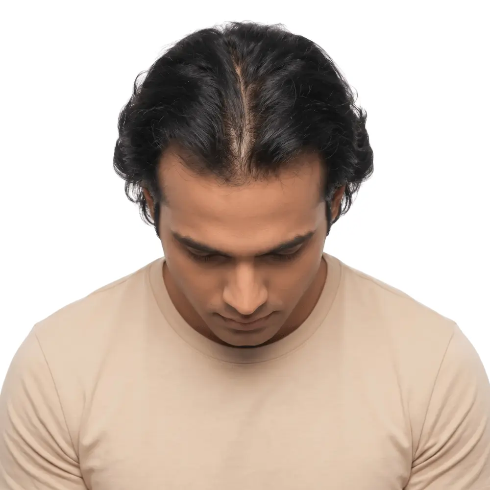 Scalp Analysis